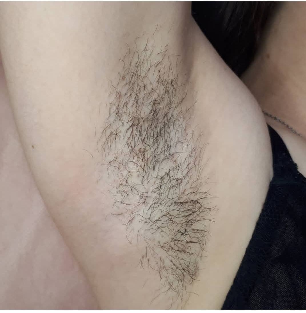 Before treatment — armpit with hair